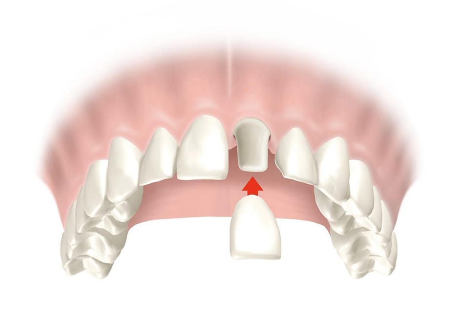 Coroane dentare