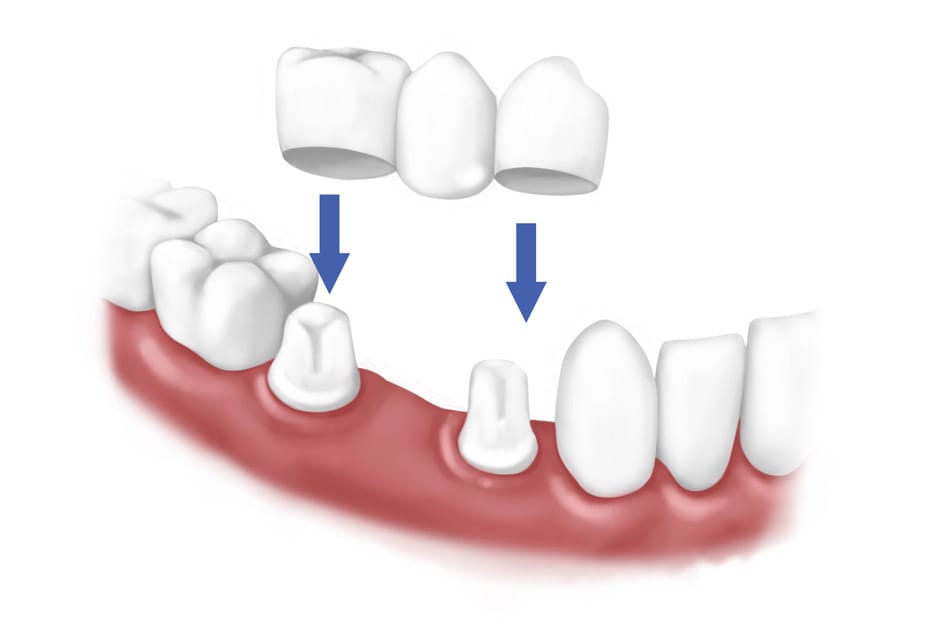 Punți dentare