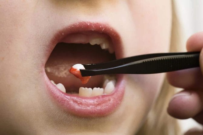 Extracția dentară